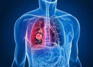R3-Dreyer-Lung RADS